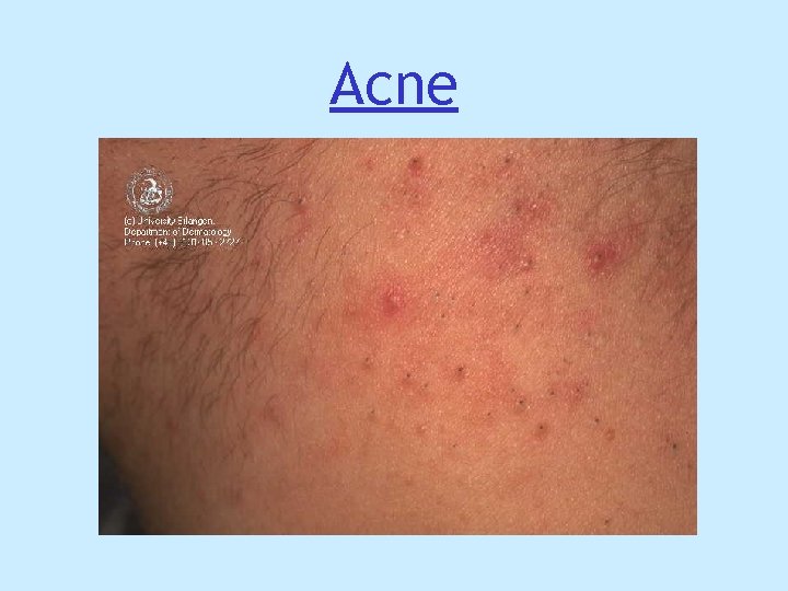Acne Acne