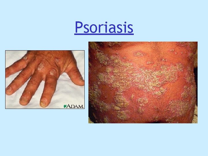 Psoriasis Psoriasis