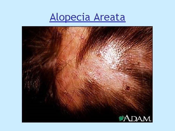 Alopecia Areata Alopecia Areata