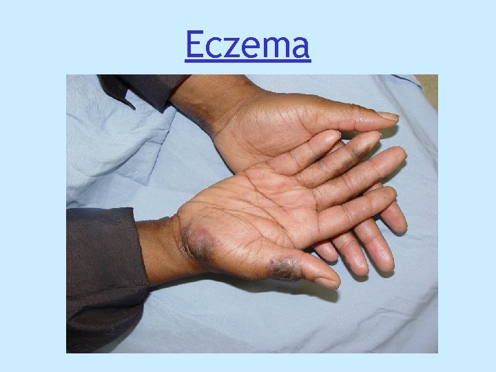 Eczema Eczema