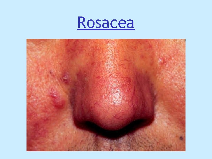 Rosacea Rosacea
