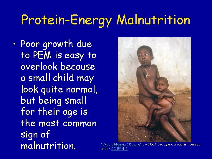 Protein-Energy Malnutrition • Poor growth due to PEM is easy to overlook because a