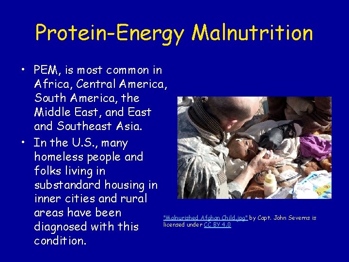 Protein-Energy Malnutrition • PEM, is most common in Africa, Central America, South America, the