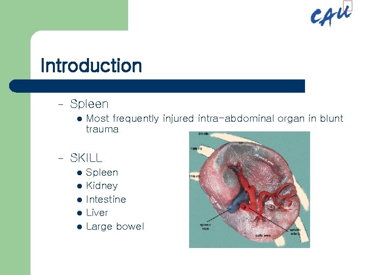 Introduction – Spleen l – Most frequently injured intra-abdominal organ in blunt trauma SKILL