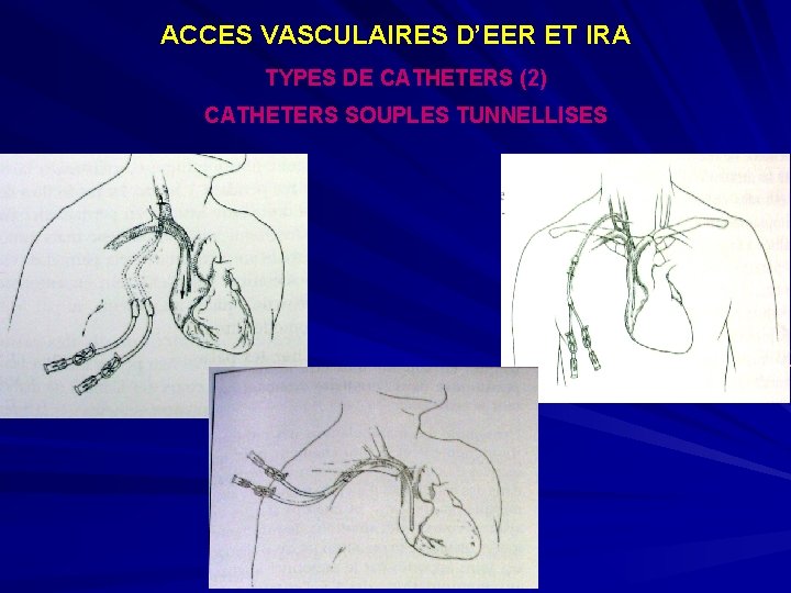 ACCES VASCULAIRES D’EER ET IRA TYPES DE CATHETERS (2) CATHETERS SOUPLES TUNNELLISES 