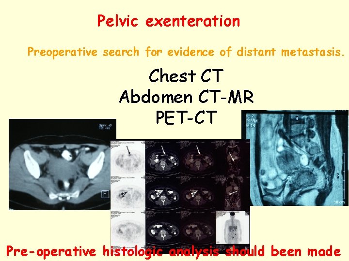 Pelvic exenteration Preoperative search for evidence of distant metastasis. Chest CT Abdomen CT-MR PET-CT