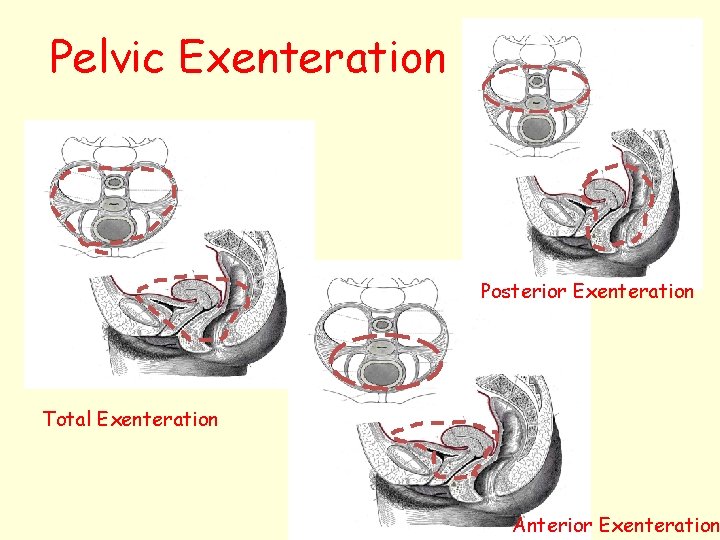 Pelvic Exenteration Posterior Exenteration Total Exenteration Anterior Exenteration 