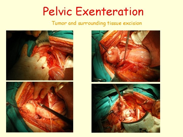 Pelvic Exenteration Tumor and surrounding tissue excision 