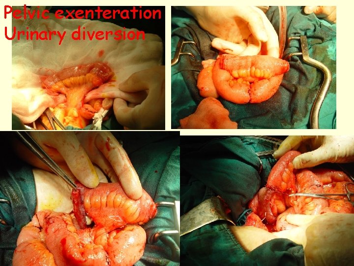 Pelvic exenteration Urinary diversion 