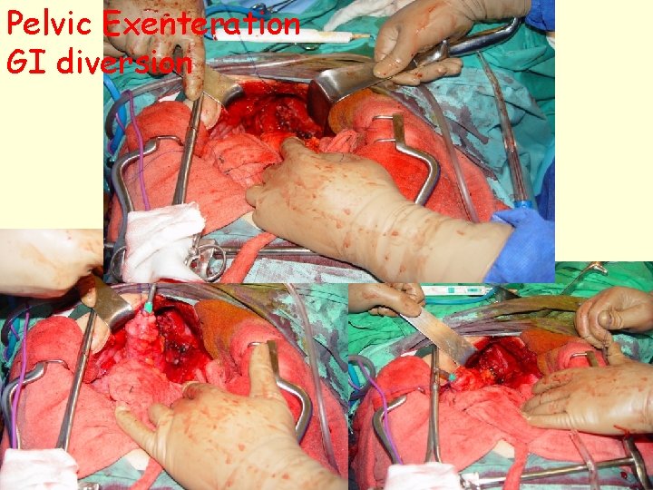 Pelvic Exenteration GI diversion 