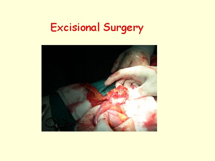 Excisional Surgery 