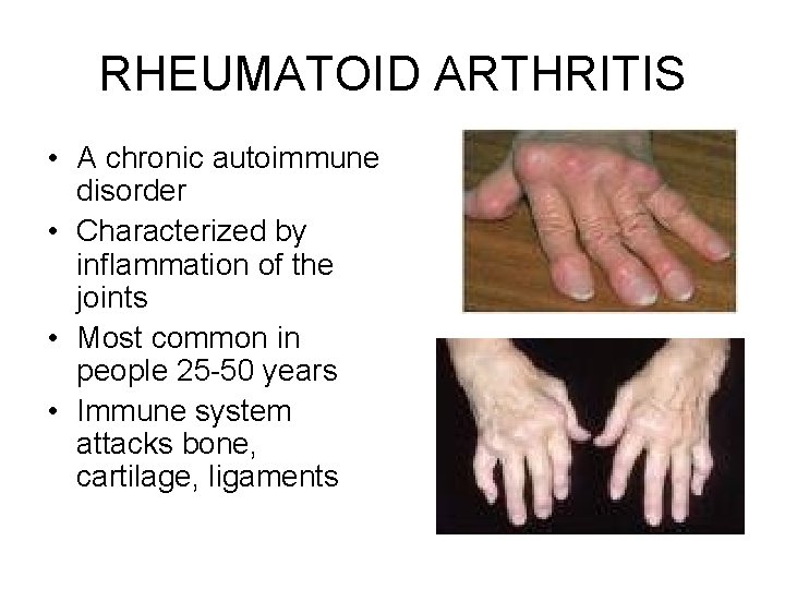 RHEUMATOID ARTHRITIS • A chronic autoimmune disorder • Characterized by inflammation of the joints