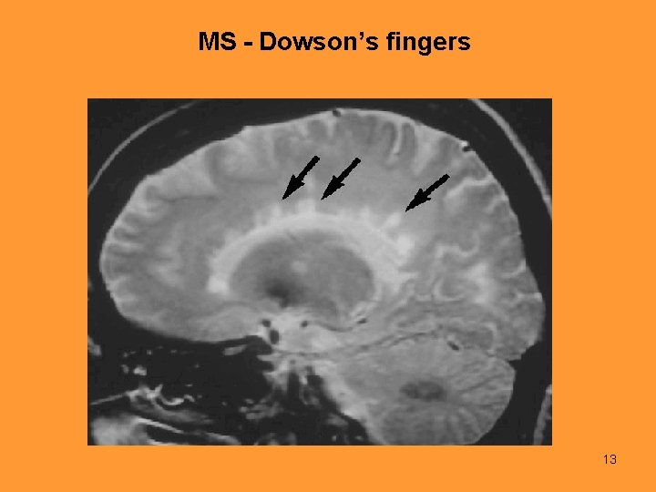 MS - Dowson’s fingers 13 