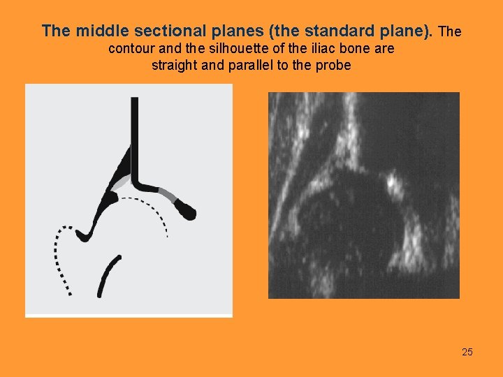 The middle sectional planes (the standard plane). The contour and the silhouette of the