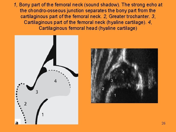 1, Bony part of the femoral neck (sound shadow). The strong echo at the