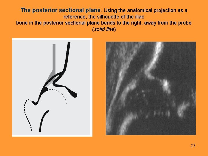 The posterior sectional plane. Using the anatomical projection as a reference, the silhouette of