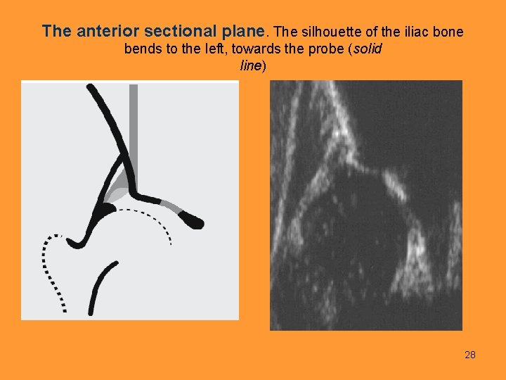 The anterior sectional plane. The silhouette of the iliac bone bends to the left,