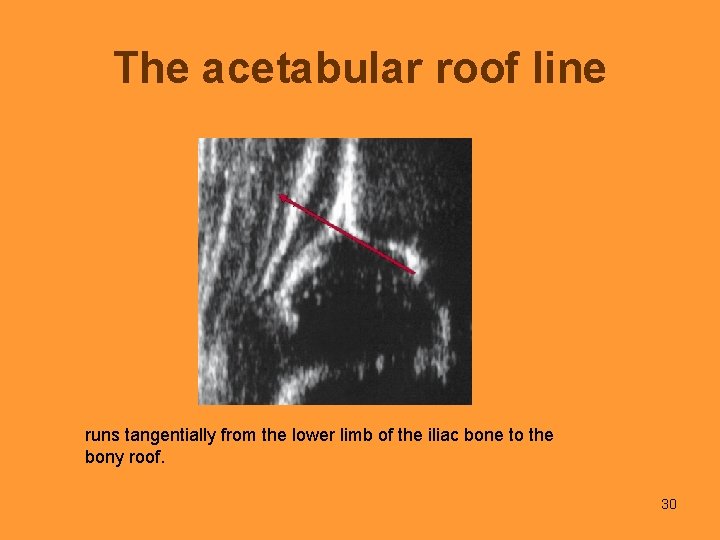 The acetabular roof line runs tangentially from the lower limb of the iliac bone