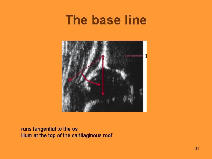 The base line runs tangential to the os ilium at the top of the