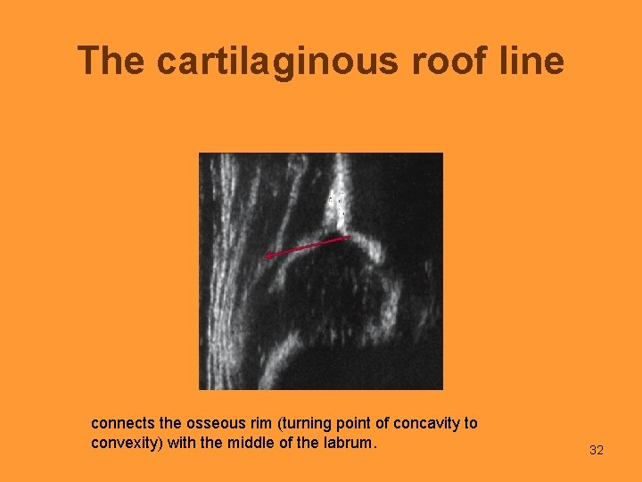 The cartilaginous roof line connects the osseous rim (turning point of concavity to convexity)