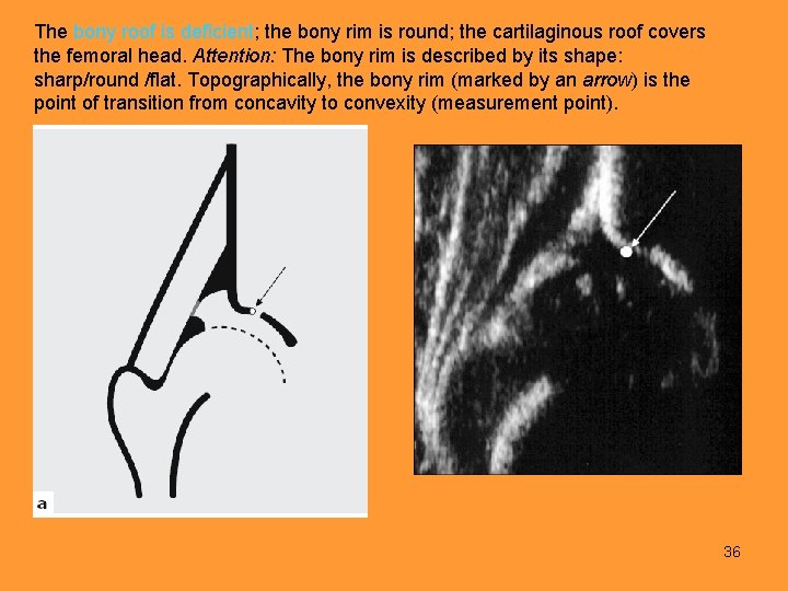 The bony roof is deficient; the bony rim is round; the cartilaginous roof covers