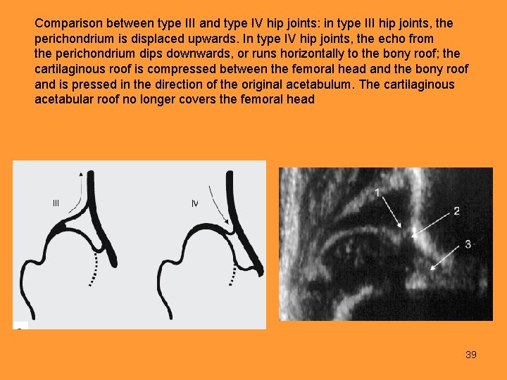 Comparison between type III and type IV hip joints: in type III hip joints,