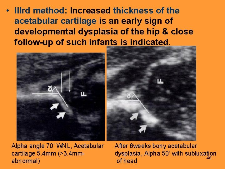  • IIIrd method: Increased thickness of the acetabular cartilage is an early sign