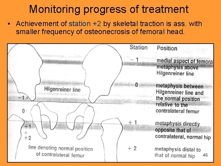 Monitoring progress of treatment • Achievement of station +2 by skeletal traction is ass.