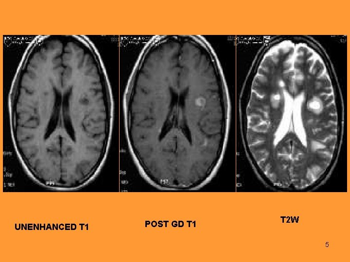 UNENHANCED T 1 POST GD T 1 T 2 W 5 