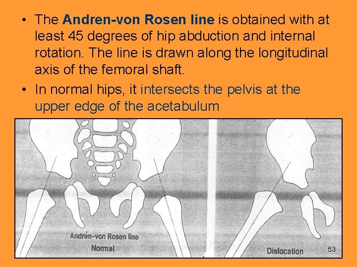  • The Andren-von Rosen line is obtained with at least 45 degrees of