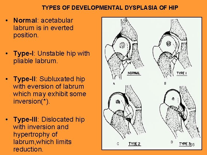 TYPES OF DEVELOPMENTAL DYSPLASIA OF HIP • Normal: acetabular labrum is in everted position.
