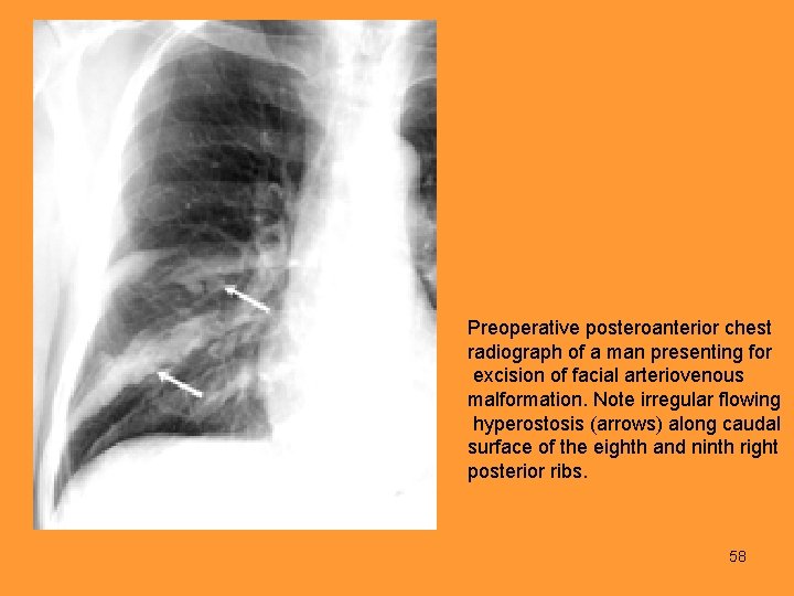 Preoperative posteroanterior chest radiograph of a man presenting for excision of facial arteriovenous malformation.