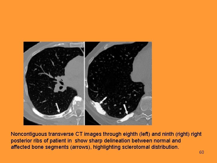 Noncontiguous transverse CT images through eighth (left) and ninth (right) right posterior ribs of