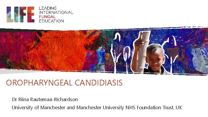 OROPHARYNGEAL CANDIDIASIS Dr Riina Rautemaa-Richardson University of Manchester and Manchester University NHS Foundation Trust, OROPHARYNGEAL CANDIDIASIS Dr Riina Rautemaa-Richardson University of Manchester and Manchester University NHS Foundation Trust,