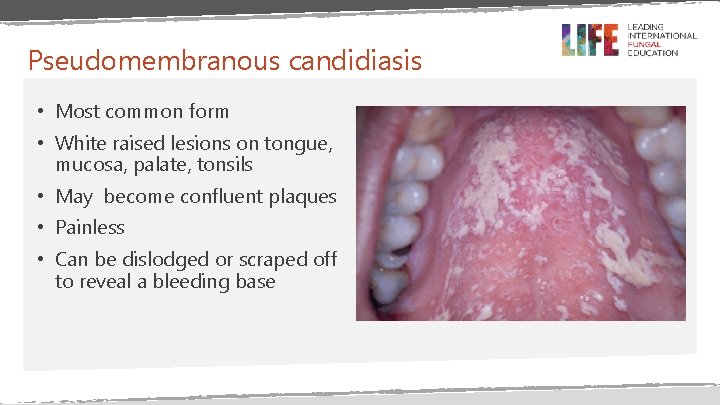 Pseudomembranous candidiasis • Most common form • White raised lesions on tongue, mucosa, palate, Pseudomembranous candidiasis • Most common form • White raised lesions on tongue, mucosa, palate,