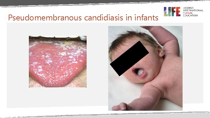 Pseudomembranous candidiasis in infants Pseudomembranous candidiasis in infants