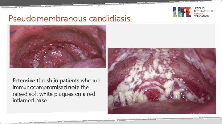 Pseudomembranous candidiasis Extensive thrush in patients who are immunocompromised note the raised soft white Pseudomembranous candidiasis Extensive thrush in patients who are immunocompromised note the raised soft white