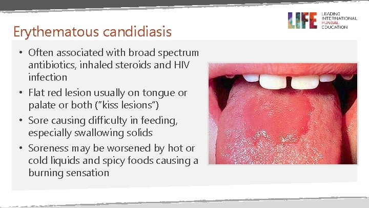 Erythematous candidiasis • Often associated with broad spectrum antibiotics, inhaled steroids and HIV infection Erythematous candidiasis • Often associated with broad spectrum antibiotics, inhaled steroids and HIV infection