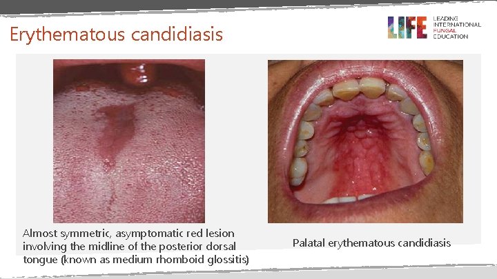 Erythematous candidiasis Almost symmetric, asymptomatic red lesion involving the midline of the posterior dorsal Erythematous candidiasis Almost symmetric, asymptomatic red lesion involving the midline of the posterior dorsal