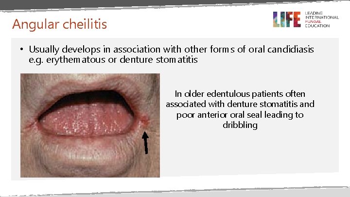 Angular cheilitis • Usually develops in association with other forms of oral candidiasis e. Angular cheilitis • Usually develops in association with other forms of oral candidiasis e.