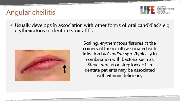 Angular cheilitis • Usually develops in association with other forms of oral candidiasis e. Angular cheilitis • Usually develops in association with other forms of oral candidiasis e.