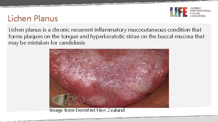 Lichen Planus Lichen planus is a chronic recurrent inflammatory mucocutaneous condition that forms plaques Lichen Planus Lichen planus is a chronic recurrent inflammatory mucocutaneous condition that forms plaques