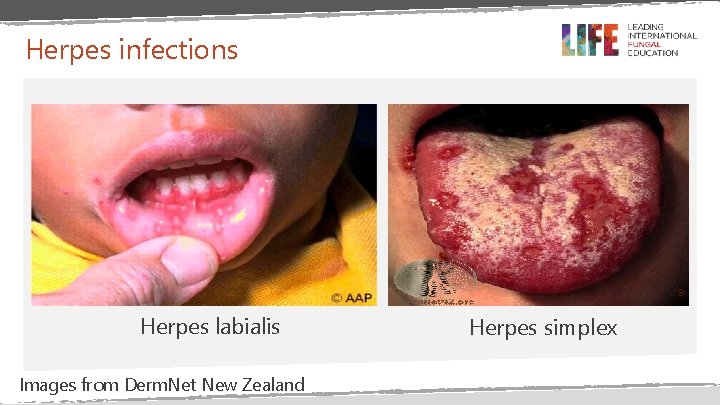 Herpes infections Herpes labialis Images from Derm. Net New Zealand Herpes simplex Herpes infections Herpes labialis Images from Derm. Net New Zealand Herpes simplex