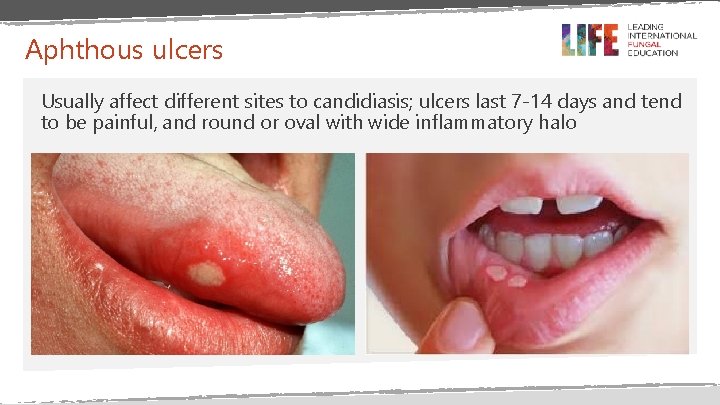 Aphthous ulcers Usually affect different sites to candidiasis; ulcers last 7 -14 days and Aphthous ulcers Usually affect different sites to candidiasis; ulcers last 7 -14 days and