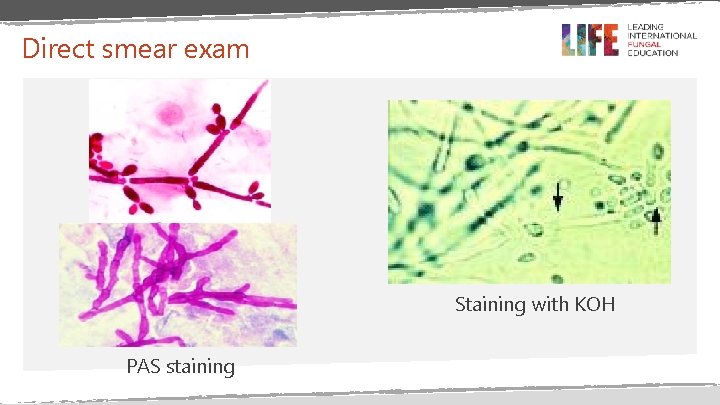 Direct smear exam Staining with KOH PAS staining Direct smear exam Staining with KOH PAS staining