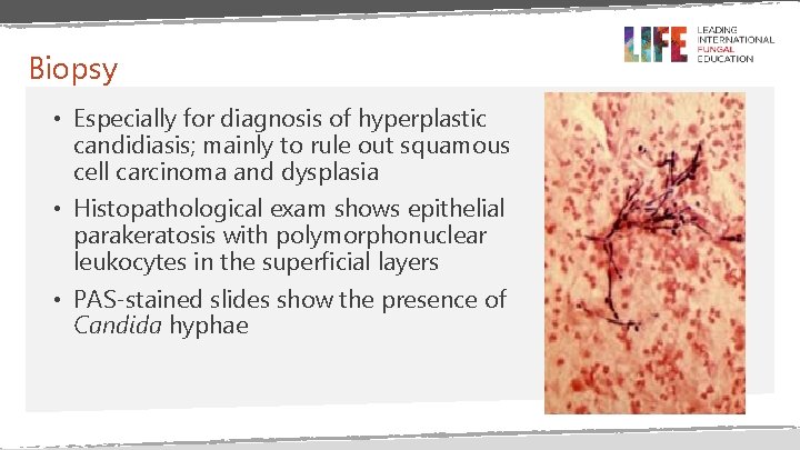 Biopsy • Especially for diagnosis of hyperplastic candidiasis; mainly to rule out squamous cell Biopsy • Especially for diagnosis of hyperplastic candidiasis; mainly to rule out squamous cell