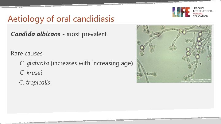 Aetiology of oral candidiasis Candida albicans - most prevalent Rare causes C. glabrata (increases Aetiology of oral candidiasis Candida albicans - most prevalent Rare causes C. glabrata (increases