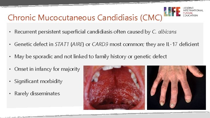 Chronic Mucocutaneous Candidiasis (CMC) • Recurrent persistent superficial candidiasis often caused by C. albicans Chronic Mucocutaneous Candidiasis (CMC) • Recurrent persistent superficial candidiasis often caused by C. albicans