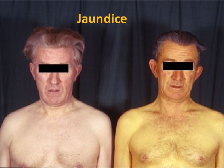 Jaundice 