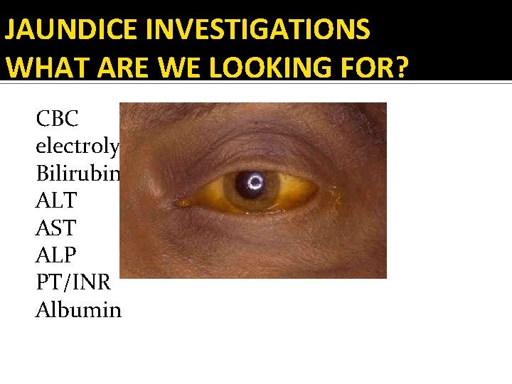 JAUNDICE INVESTIGATIONS WHAT ARE WE LOOKING FOR? CBC electrolytes Bilirubin (Direct/Indirect) ALT AST ALP